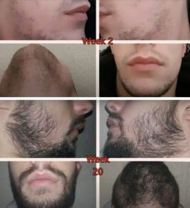 Minoxidil az állhoz